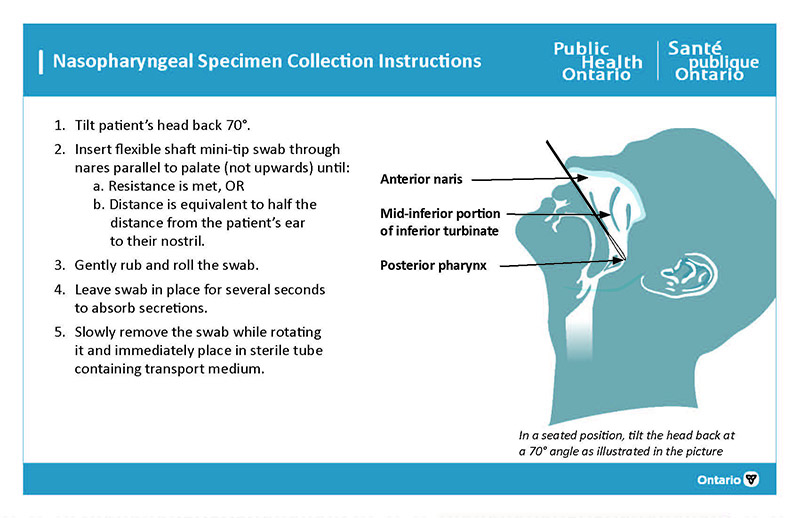 Photo of nasopharyngeal specimen collection